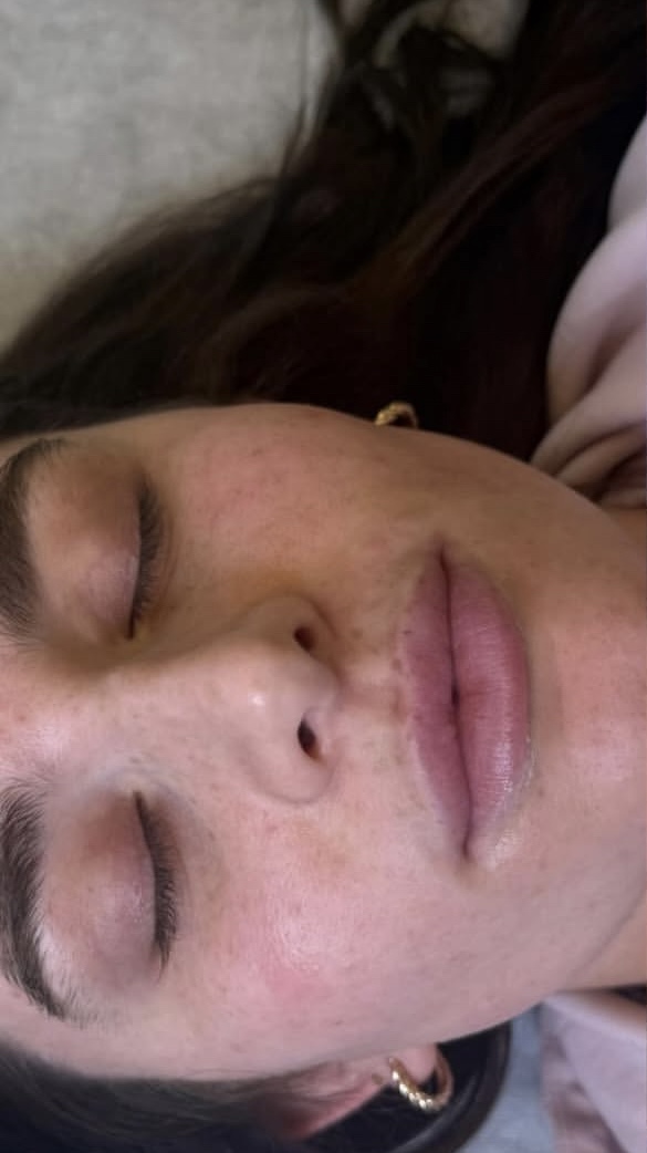 Lips before treatment